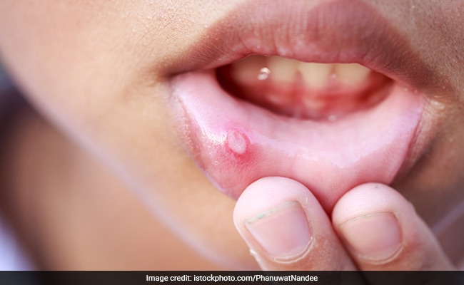 Treat Mouth Ulcers With This Unique Method
