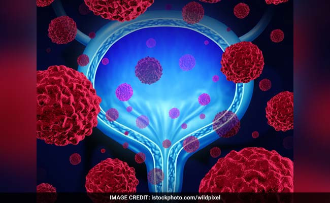 Prostate Cancer क्या है?  डॉक्टर से जानें प्रोस्टेट कैंसर के लक्षण, कारण, इलाज और बचाव के उपाय