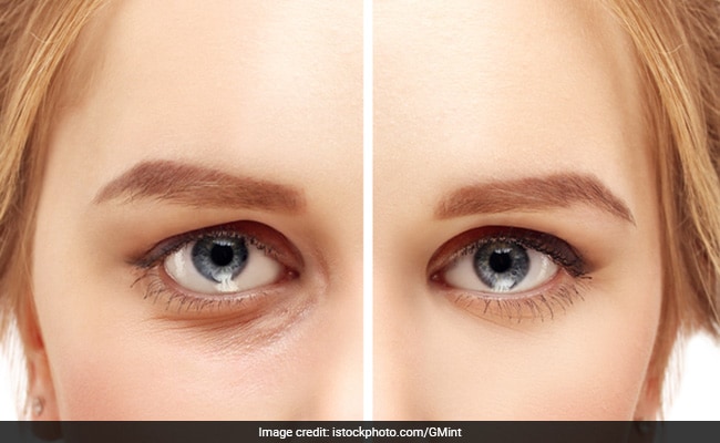 Say Goodbye To Puffy Eyes And Dark Circles With These Remedies