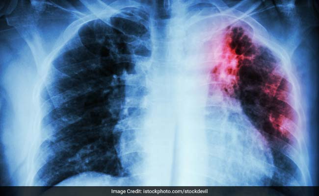 Vitamin D Deficiency Could Take A Severe Toll On Lungs: 5 Vitamin D Rich Foods