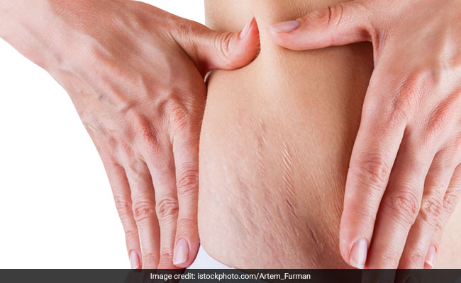 Stretch Marks And You: A 4-Step Guide To Minimising Them