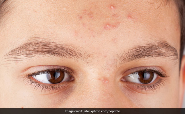 Want A Quick-Fix To Get Rid Of Acne? Try These 3 Hacks Suggested By Dermatologist Dr Jaishree Sharad Want A Quick-Fix To Get Rid Of Acne? Try These 3 Hacks Suggested By Dermatologist Dr Jaishree Sharad