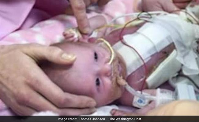 Baby Was Born With Her Heart Outside Body - And Survived