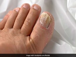 Iron Deficiency Symptoms: ये 5 संकेत देते हैं शरीर में आयरन की कमी का इशारा, नोटिस करें नहीं तो बाद में होगी दिक्कत Iron Deficiency Symptoms: ये 5 संकेत देते हैं शरीर में आयरन की कमी का इशारा, नोटिस करें नहीं तो बाद में होगी दिक्कत