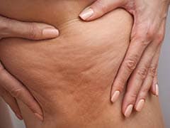 Weight Loss Tips: These Tips Can Help Reduce Cellulite