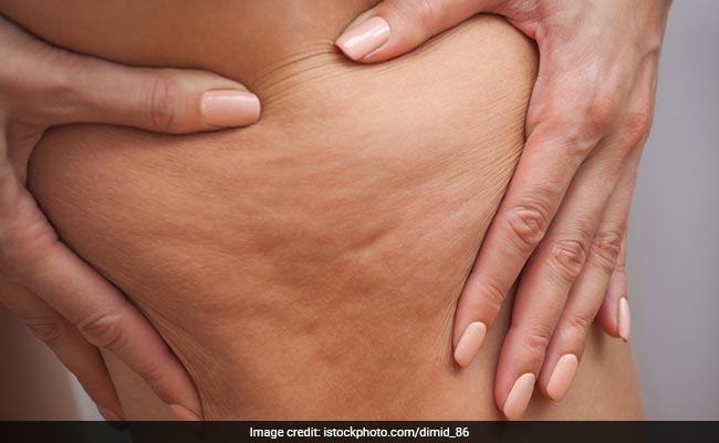 Weight Loss: जाघों और पेट पर गड्ढेदार स्किन को ठीक करने के लिए करें ये काम, सेल्युलाईट स्किन होगी नॉर्मल