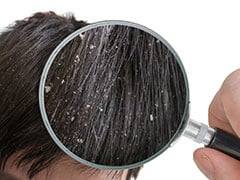 This Simple Yet Effective Home Remedy Is All You Need To Keep Dandruff Issues At Bay