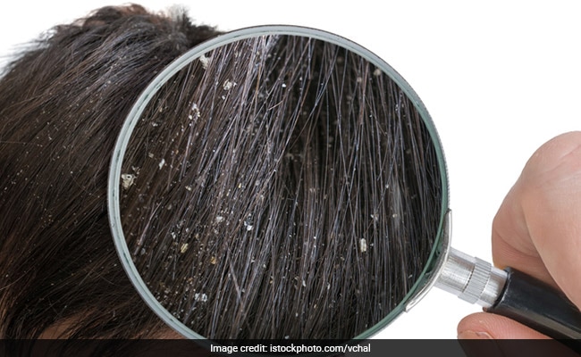 डैंड्रफ को जड़ से खत्म करने के लिए 5 Hair Mask