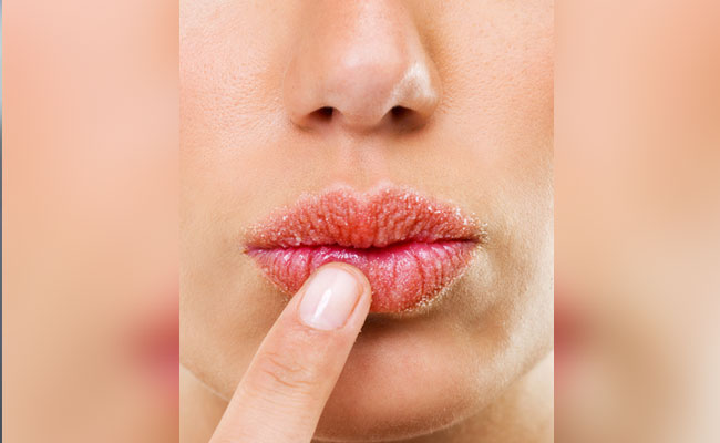 Chapped Lips In Winter? Expert Lists Reasons And Solution