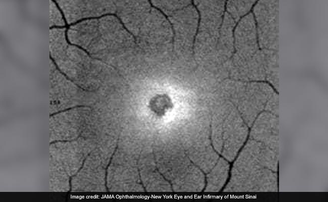 The Solar Eclipse Burned A Crescent Wound On A Woman's Retina. She Wasn't Wearing Proper Glasses