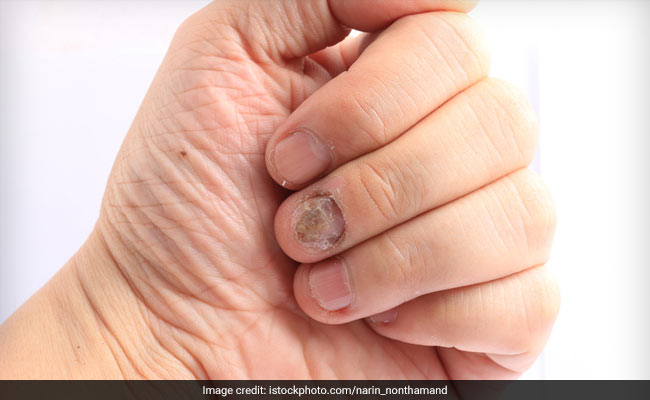 Know All About The Candida Diet And How It Makes You Lose Weight