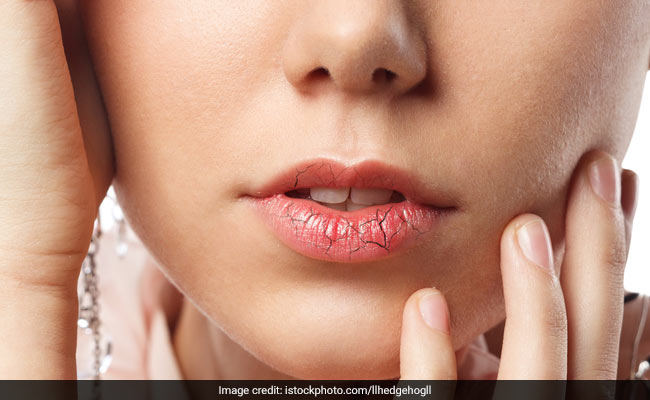 Winter Lip Care Tips : सर्दियों में ऐसे रखें होंठों का ख्याल, कर लिए ये काम तो नहीं फटेंगे होंठ