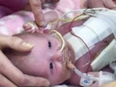 Baby Born With Heart And Part Of Her Stomach Outside Her Body!