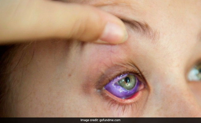A Model Tattooed Her Eyeball Purple. She Now Could Lose Her Eye.