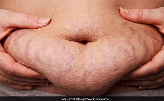 Terrific Tips To Reduce Stretch Marks After Losing Weight