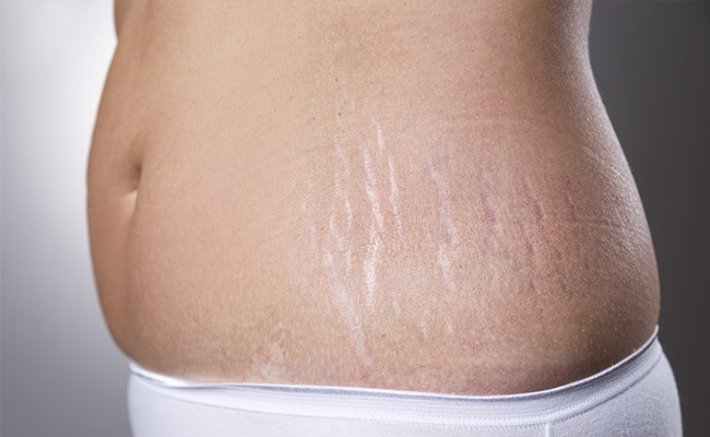 लगी शर्त! स्ट्रेच मार्क्स से जुड़े 5 अमेज़िंग फैक्ट्स के बारे में नहीं जानते होंगे आप