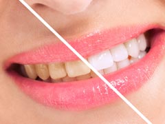 दांतों की सफाई के नुस्खे, कैसे पाएं सफेद और मजबूत दांत...