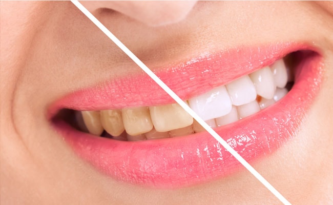 Teeth Whitening Tips: दांतों का पीलापन करना चाहते हैं दूर, तो अपनाएं ये तीन आसान उपाय!