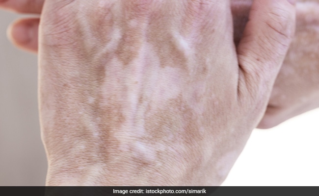 7 Reasons For White Spots On Your Skin