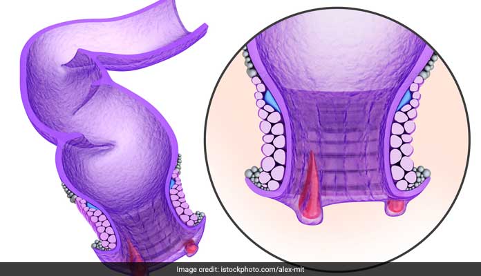 Anal Fissure Treatment: Yoga for Anal Fissure, Home Remedies