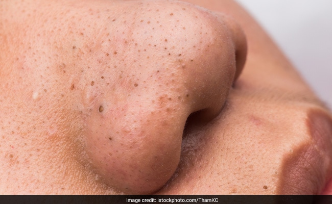 Blackhead Removal