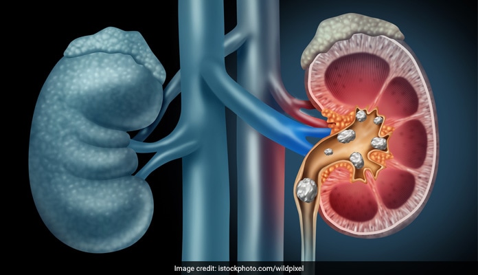 can taking calcium carbonate cause kidney stones