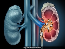 Bad Food For Kidney: ये 6 चीजें आपकी किडनी कर सकती हैं खराब, भूलकर भी न करें सेवन Bad Food For Kidney: ये 6 चीजें आपकी किडनी कर सकती हैं खराब, भूलकर भी न करें सेवन