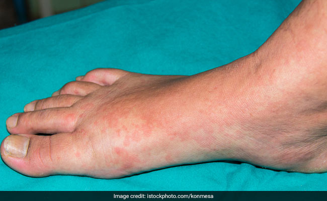 Causes Of Hives: शीतपित्त क्या है, किन लोगों को सबसे ज्यादा होता है? जानें इससे बचने के आसान तरीके