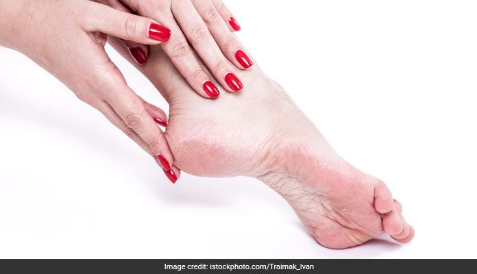 Cracked Heels Treatment - Advanced Dermatology of the Midlands