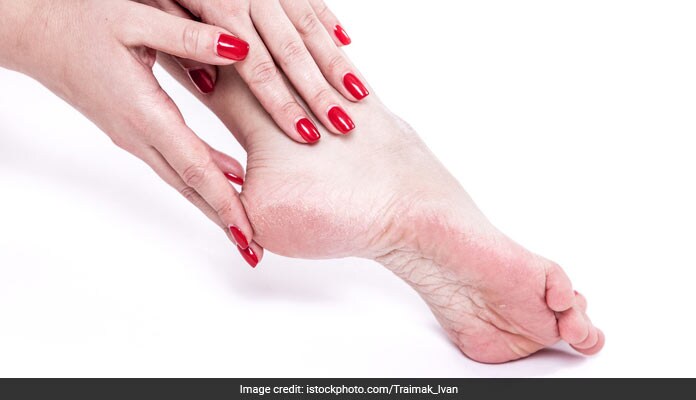 7 Effective Tips To Treat Cracked Heels