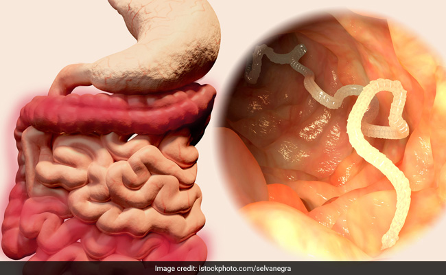 Shocking! Hookworm Sucked 22 Litres Of Blood From A 14-Year Old In 2 Years