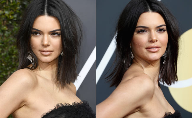 Acne (And Trolls), You've Got Nothing On Kendall Jenner