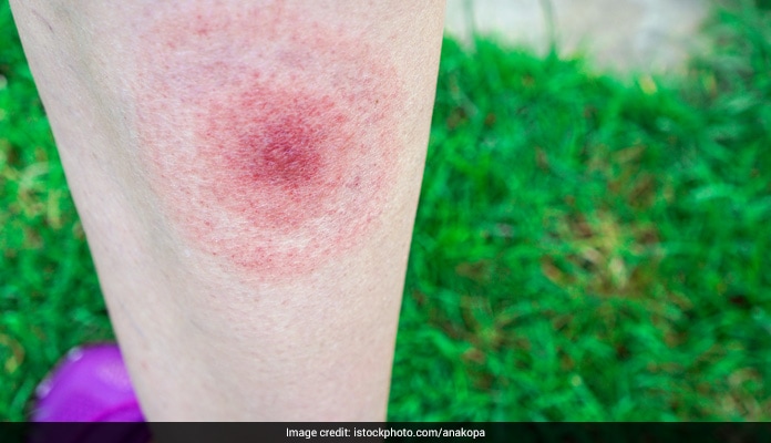 Do You Know What Lyme Disease Is? Know The Symptoms, Diagnosis and ...