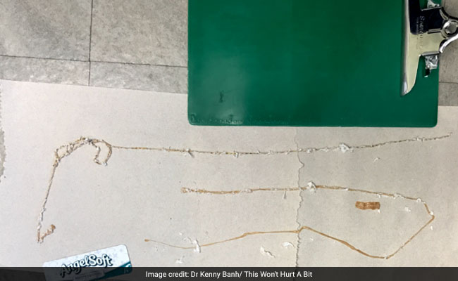He Ate Raw Fish Almost Daily - Until 5-Foot Tapeworm Wiggled Out Of Him