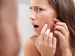 Sudden Acne Breakout: Causes And Tips For Prevention