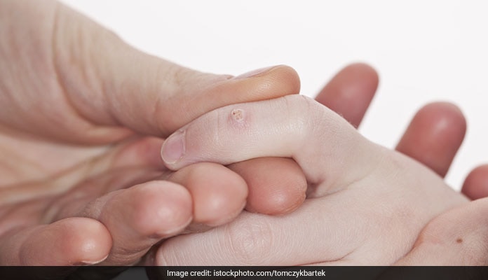 how to get rid of warts at home