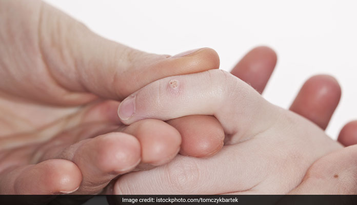 7 Home Remedies To Get Rid Of Warts