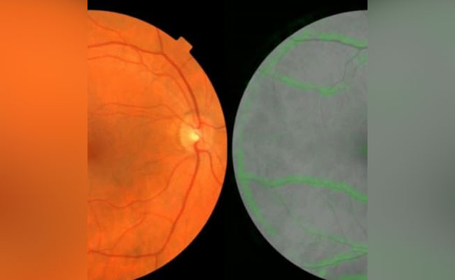 Google's AI Can Look At Our Eyes And Predict Heart Attack Risk
