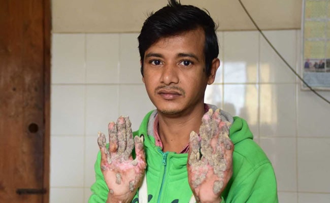 After 24 Surgeries, Bangladesh 'Tree Man' Relapses