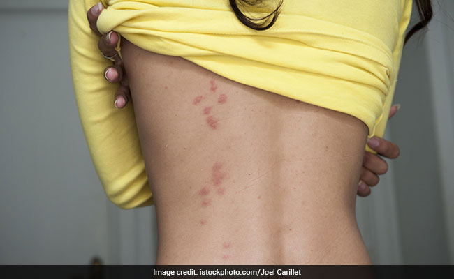 What Are Bedbug Bites And Flea Bites? Know The Difference