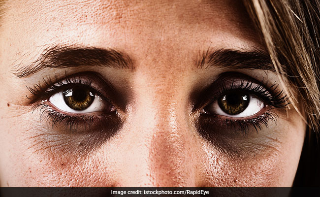 Dark Circles हमेशा के लिए खत्म करेगा ये तेल, ऐसे करें इस्तेमाल