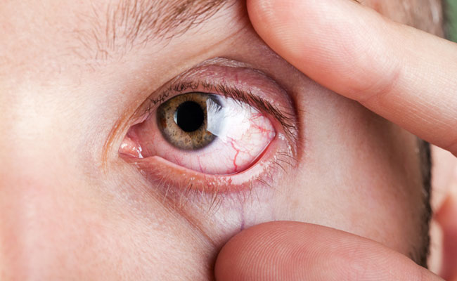 Here's How You Can Get Rid Of Dry Eyes