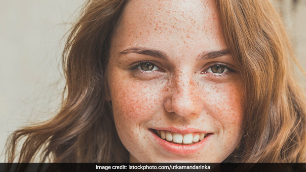 5 Natural Ways to Get Rid Of Freckles On Face