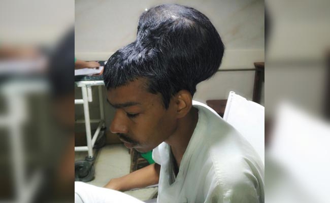 Mumbai Man's Huge Tumour "Sat Like A Head On Top Of Another Head"