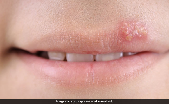 herpes appear on the lips and mouth
