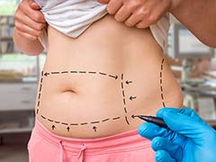 5 Things To Know If You're Considering Liposuction