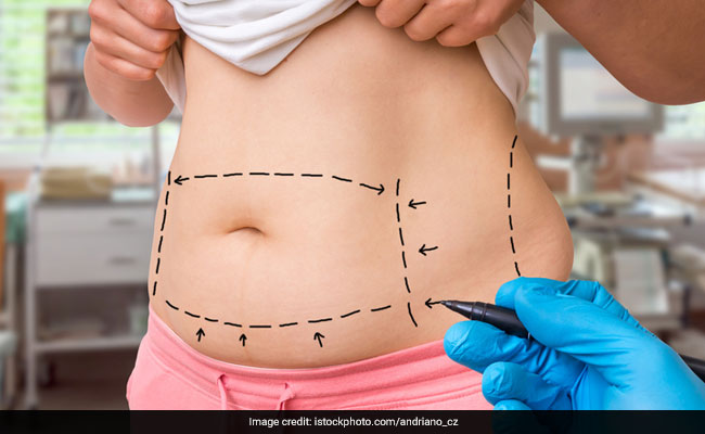 5 Things To Know If You're Considering Liposuction