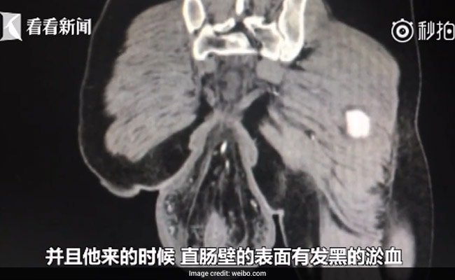 Man's Rectum Fell Out Of Body After Sitting On The Toilet For 30 Minutes