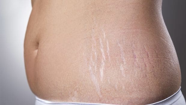 stretch marks