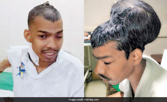 दुनिया की सबसे बड़ी ब्रेन ट्यूमर सर्जरी, सिर से निकाला 1.8 किलो ट्यूमर